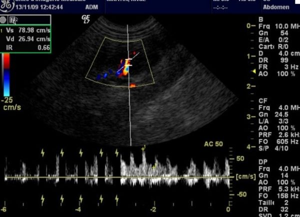 Fonction Doppler En Echographie